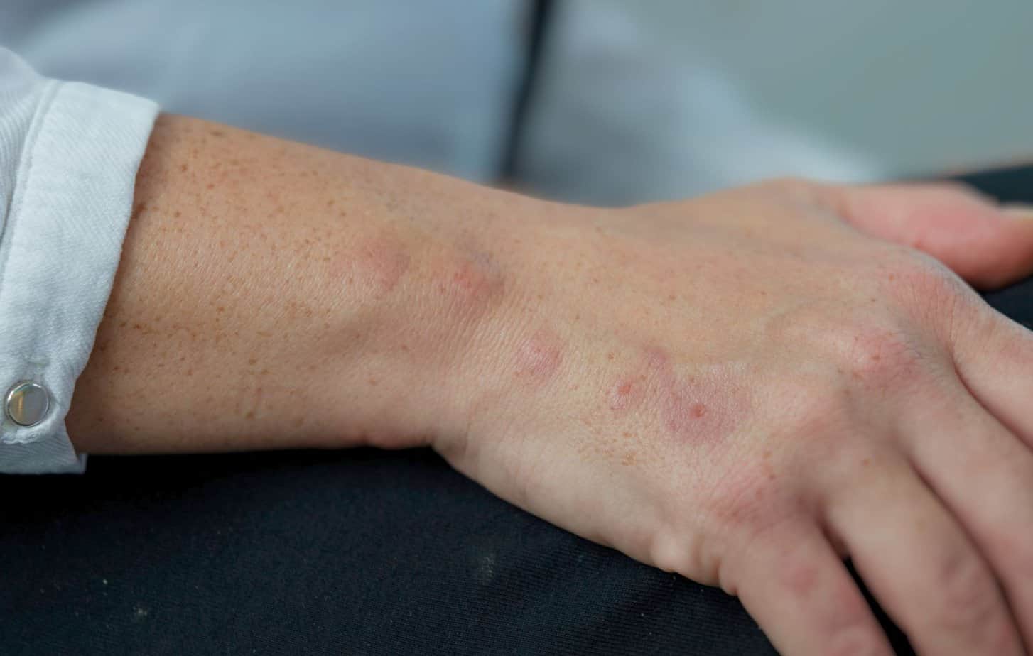 Six Inflamed bed bug bites in a row from wrist to pinkie knuckle on left hand of white person.